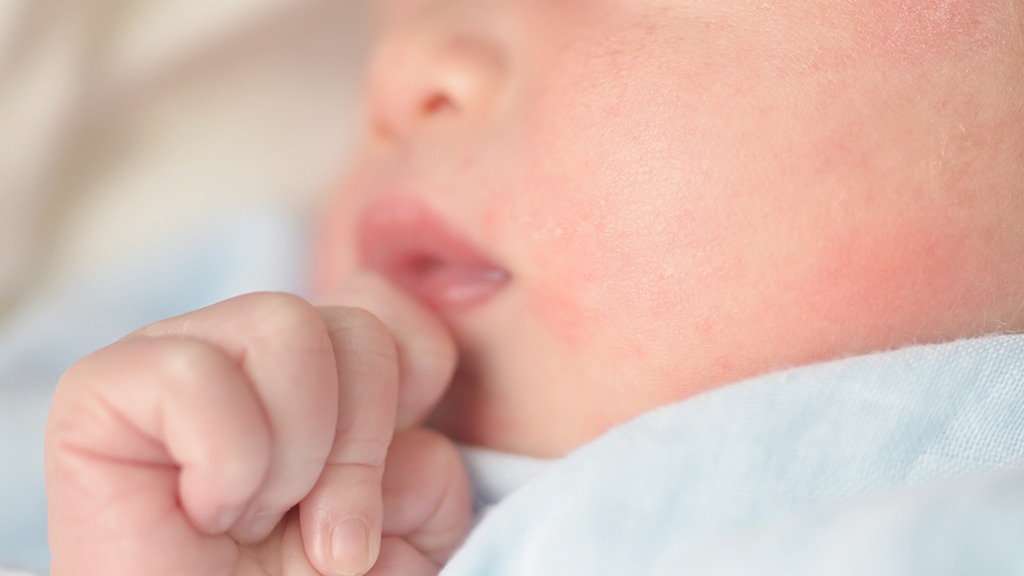 保養知識-綠果學堂-綠果寶寶肌膚過敏？