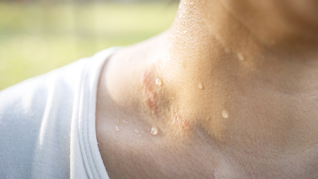 保養知識-綠果學堂-汗水會引起搔癢