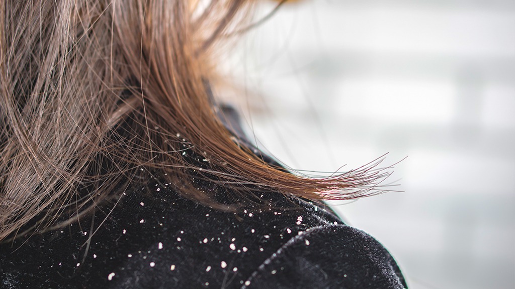 保養知識-綠果學堂-皮脂分泌過剩容易產生頭皮屑